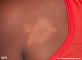 leprosy tuberculoid