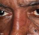 leprosy tuberculoid