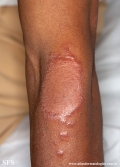 leprosy tuberculoid