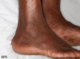 leprosy tuberculoid