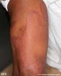 leprosy tuberculoid