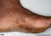 leprosy tuberculoid