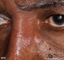 leprosy tuberculoid