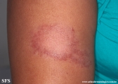 leprosy tuberculoid