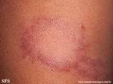 leprosy tuberculoid
