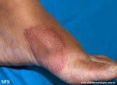 leprosy tuberculoid