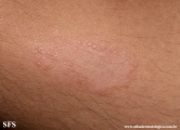 leprosy tuberculoid