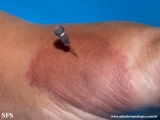 leprosy tuberculoid