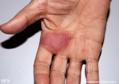 leprosy tuberculoid