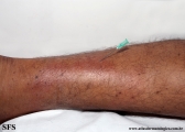 leprosy tuberculoid