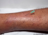 leprosy tuberculoid