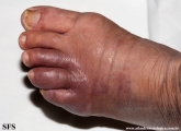 leprosy tuberculoid