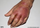leprosy tuberculoid