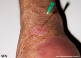 leprosy tuberculoid