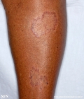 leprosy tuberculoid