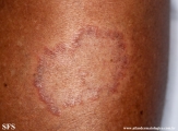 leprosy tuberculoid