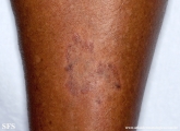leprosy tuberculoid