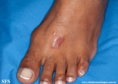 leprosy tuberculoid