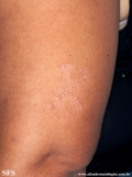 leprosy tuberculoid