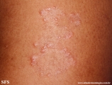 leprosy tuberculoid