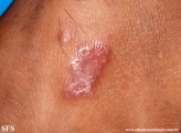 leprosy tuberculoid