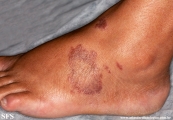 leprosy tuberculoid