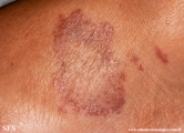 leprosy tuberculoid