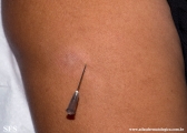 leprosy tuberculoid