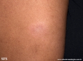 leprosy tuberculoid
