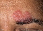 leprosy tuberculoid