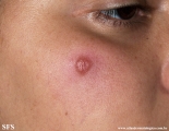 leprosy tuberculoid
