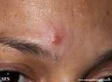 leprosy tuberculoid