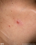 leprosy tuberculoid