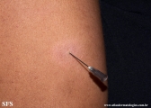 leprosy tuberculoid