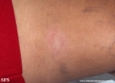 leprosy tuberculoid