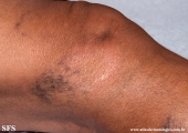 leprosy tuberculoid