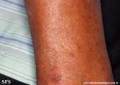 leprosy tuberculoid