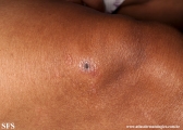 leprosy tuberculoid