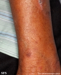leprosy tuberculoid