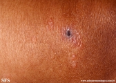 leprosy tuberculoid