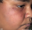 leprosy tuberculoid
