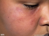 leprosy tuberculoid