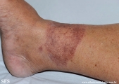 leprosy tuberculoid