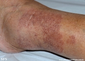 leprosy tuberculoid