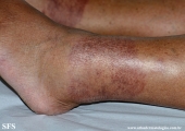 leprosy tuberculoid