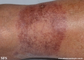 leprosy tuberculoid