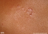 leprosy tuberculoid