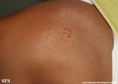 leprosy tuberculoid