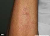 leprosy tuberculoid
