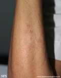 leprosy tuberculoid
